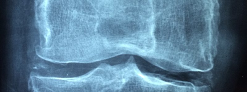 Boire de l’eau peut-il vraiment soulager l’arthrose ?